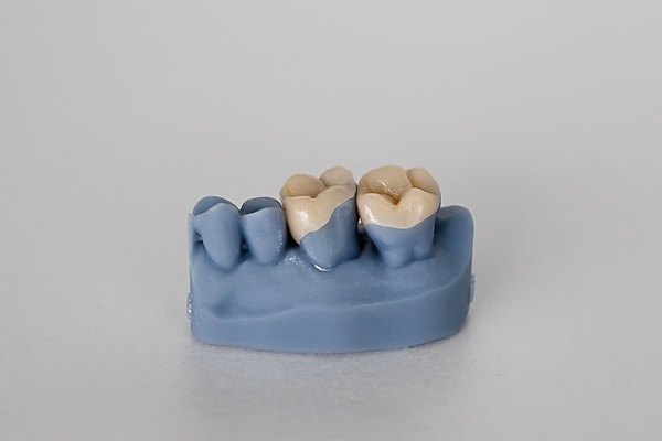Dental Inlay Vs  Crown: When To Choose An Inlay, According To A Dentist