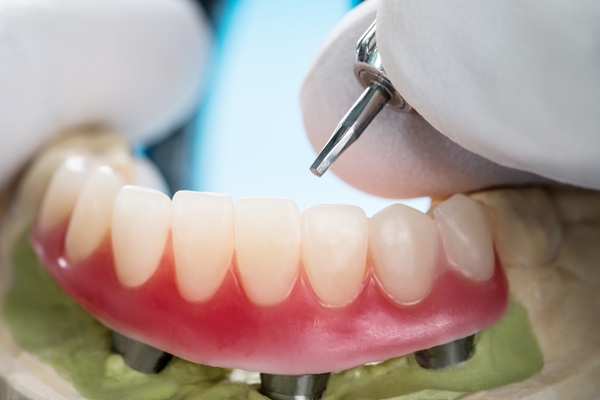 Fixed Vs  Removable Implant Supported Dentures